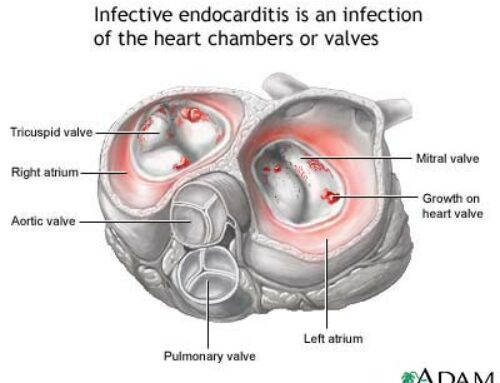 Endocardite infettiva: classificazione, definizione, profilassi